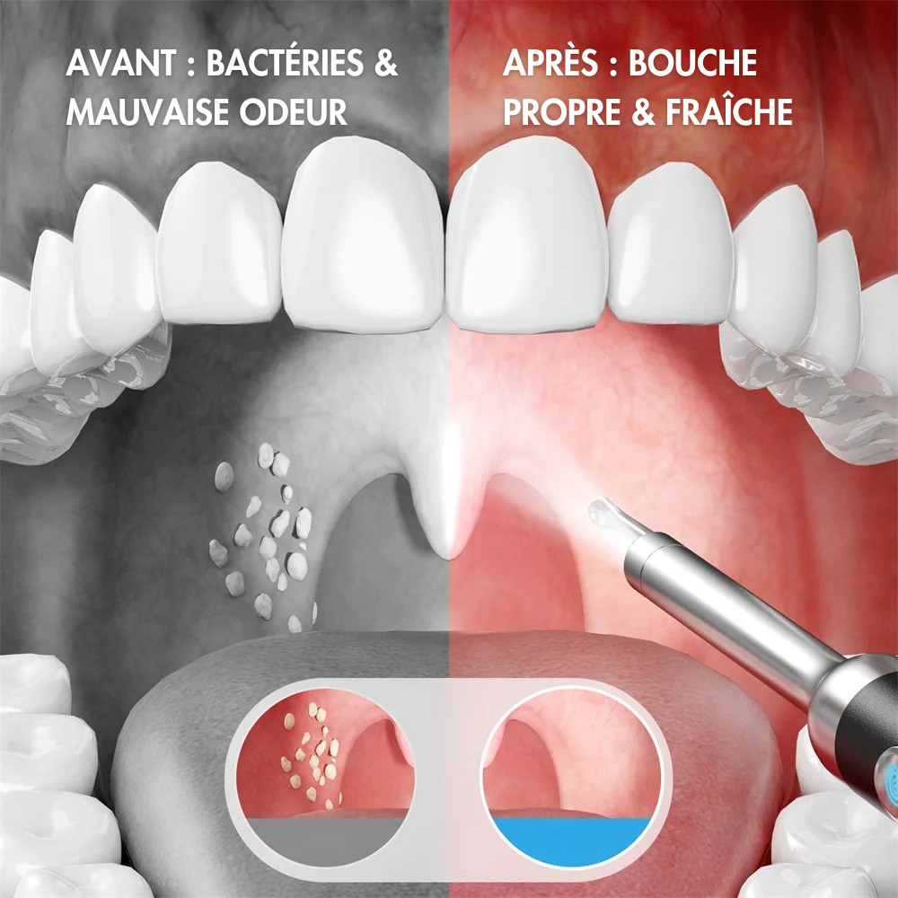 Kit de retrait de pierres d’amygdale avec caméra HD